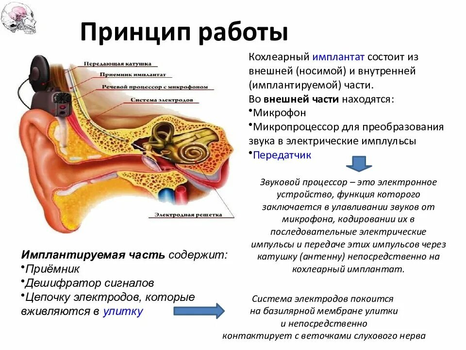 Кохлеарный имплантат нейросенсорная тугоухость. Кохлеарная имплантация уха. Кохлеарный имплант кохлеарная имплантация. Кохлеарный неврит слухового нерва. Слуховой аппарат внутреннего уха