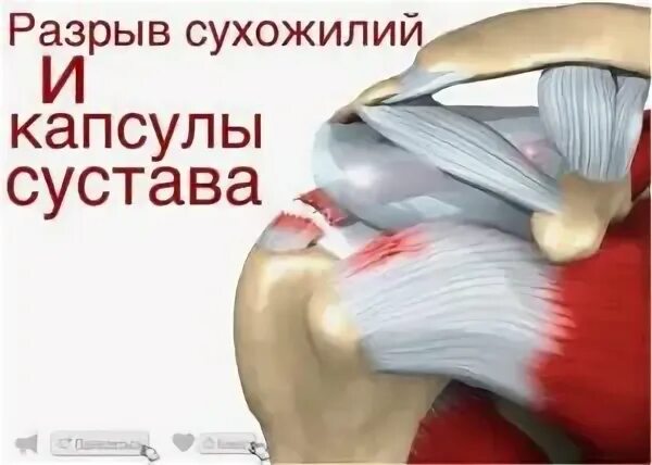 Капсульное повреждение