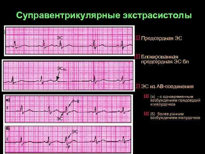парная желудочковая экстрасистолия. желудочковые экстрасистолы на экг характеризуются:. одиночная экстрасистола. одиночная желудочковая экстрасистолия. желудочковая экстрасистолия 3:1.