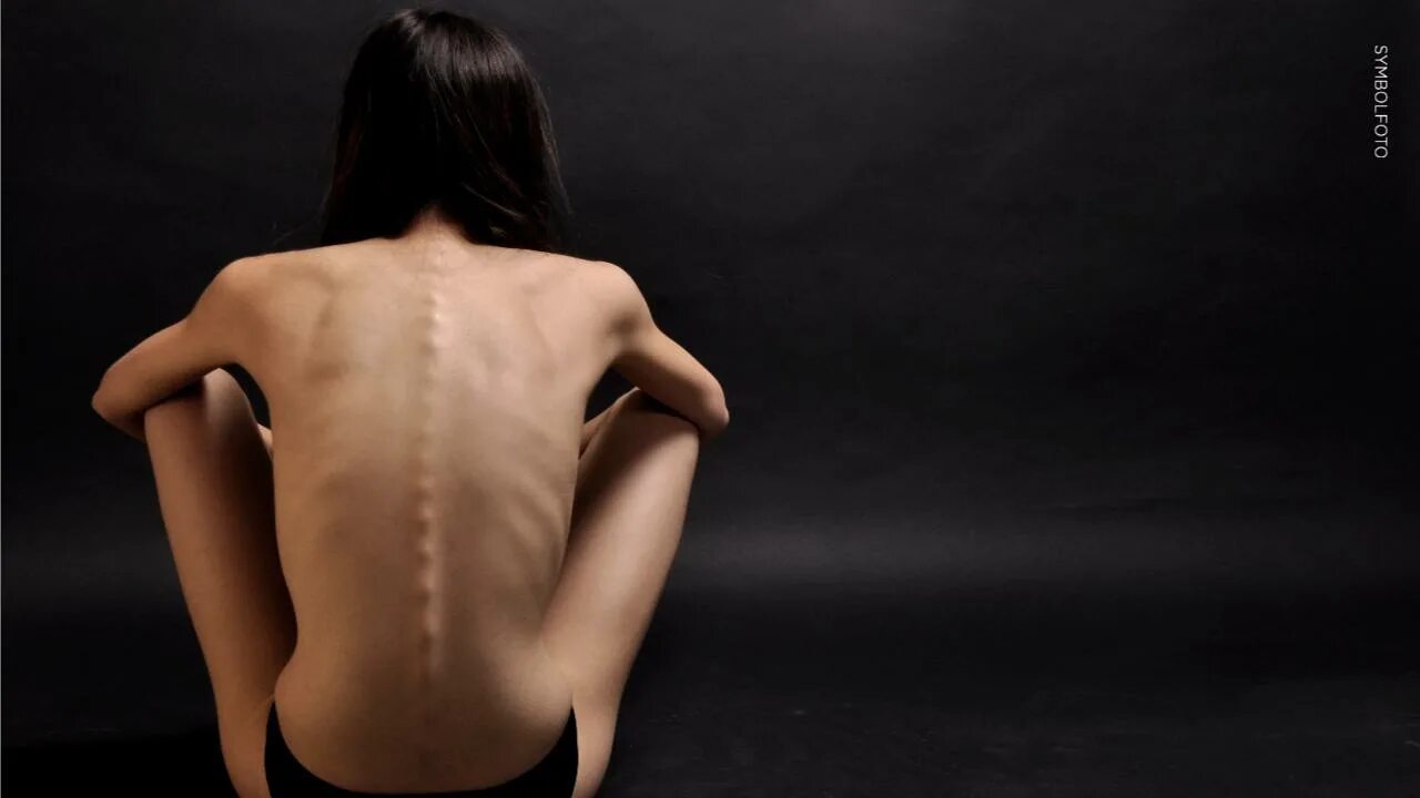 Сколиотическая деформация позвоночника. Женская спина. Как выглядит со спины. Красивая спина. Красивая осанка.