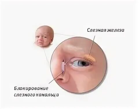 Массаж глаза у новорожденного. Непрохождение слезного канала у новорождённых. Глазу это дакриоцистит у новорожденных. В 10 месяцев зондирование слезного канала у новорожденных. Дакриоцистит новорожденных массаж слезного канала у новорожденных.