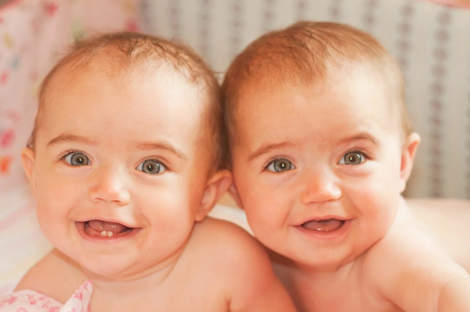 Королевская двойня. Мальчики со сросшимися мозгом. Разделили близнецов мальчиков. Двойняшки девочки новорожденные. 10 месяцев двойне.