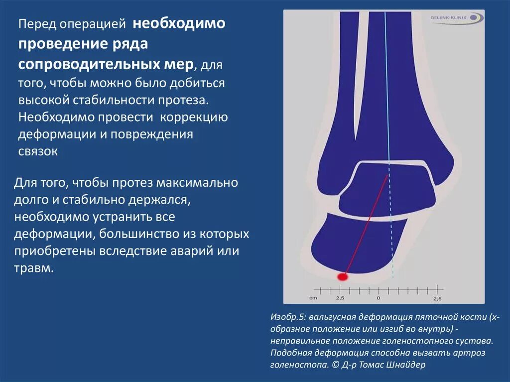 Синдромы голеностопного сустава. Эндопротезирование голеностопного сустава. Артроз голеностопного сустава презентация. Клонус голеностопного сустава. Исправление искривления голеностопа.