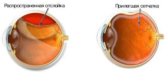 Отслойка сетчатки экстрасклеральное пломбирование. Отслойка сетчатки баллонирование склеры. Отслойка сетчатки эписклеральное пломбирование. Отслоение сетчатки операция пломба.