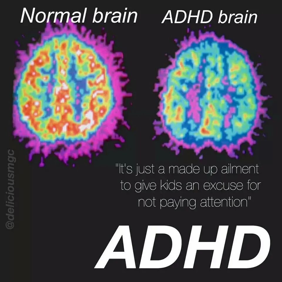 ADHD Brain. ADHD арт. ADHD Brain differences. ADHD Brain pic. Attention disorders