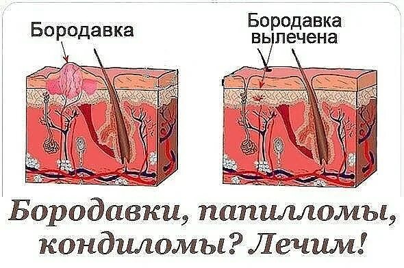 Бородавка после прижигания чистотелом