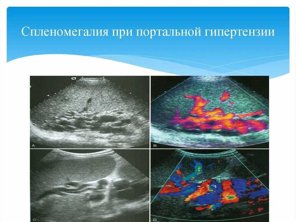 Патология селезенки. Ультразвуковая анатомия селезенки Изранов. Спленомегалия на УЗИ. Лимфосаркома селезенки УЗИ.