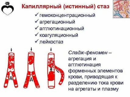 Стаз это