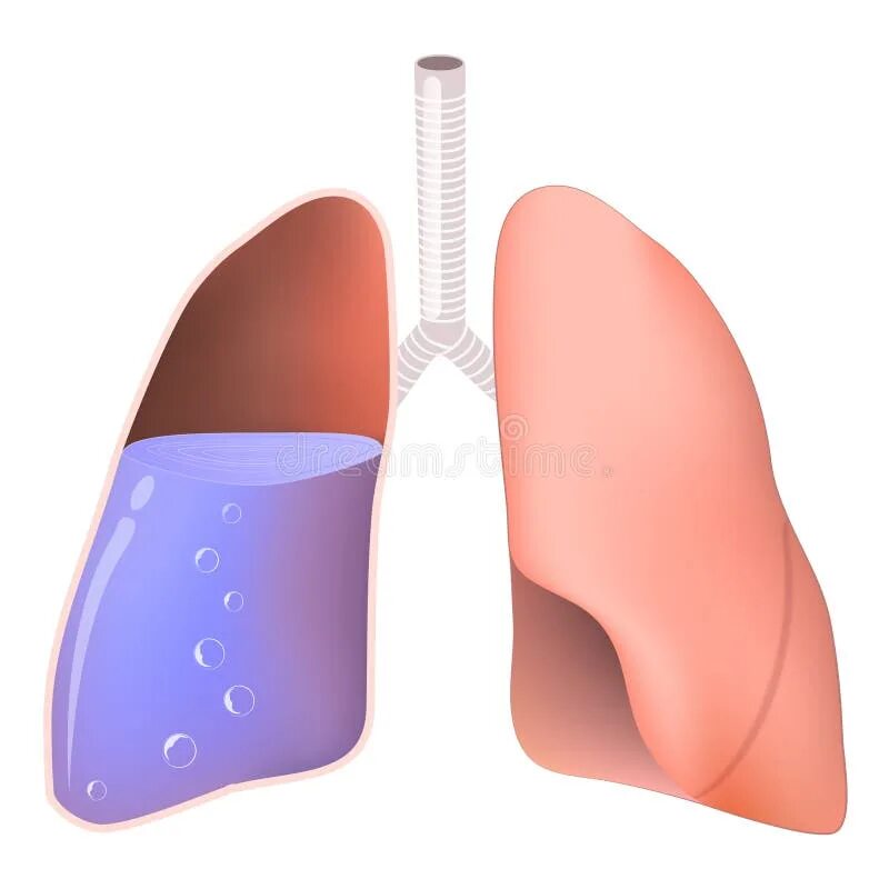 Легкие наполняются жидкостью. Лёгкие человека жидкость. Вода в легких название