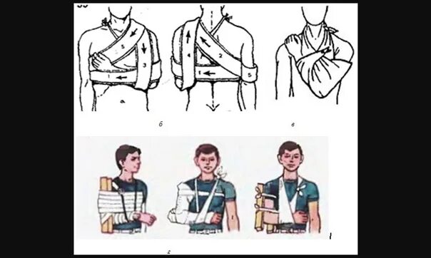 Оказание помощи при переломе ключицы. Перелом ключицы иммобилизация. перелом ключицы иммобилизация повязка. перелом ключицы иммобилизация повязка дезо. перелом ключицы транспортная иммобилизация.