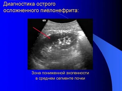 Диагноз острый пиелонефрит