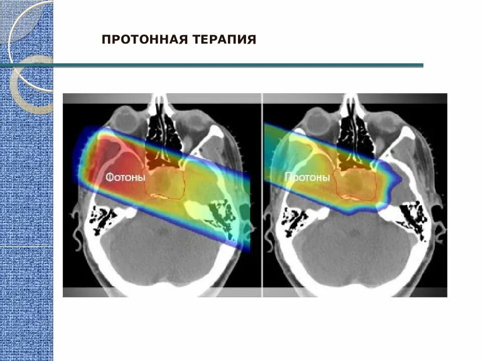 Протонная лучевая терапия. Облучение протонным пучком. Протонная лучевая терапия презентация. Протонный нож в онкологии. Протонная терапия рака