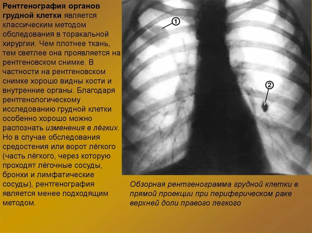 Рентгенограмма грудной клетки. Болезни легких на рентгене. Рентген органов грудной клетки в прямой проекции. Изменения на рентгенографии грудной клетки.