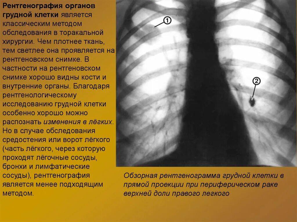 Легко ли обнаружить. Рентгенограмма грудной клетки. Болезни легких на рентгене. Рентген органов грудной клетки в прямой проекции. Изменения на рентгенографии грудной клетки.