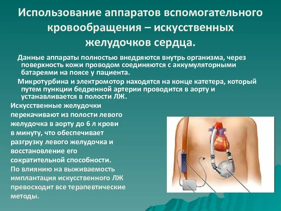 Первый в мире искусственный желудочек для сердца