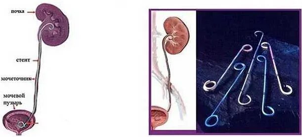 Стенд в мочеточнике стент в мочеточнике. Удаление стенда. Стент внутреннего дренирования в мочеточнике. Чрескожная нефростомия. Удаление стенда.