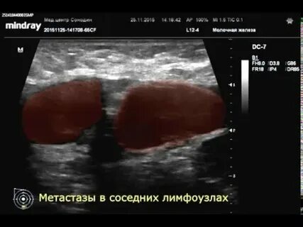 Мтс лимфоузлов