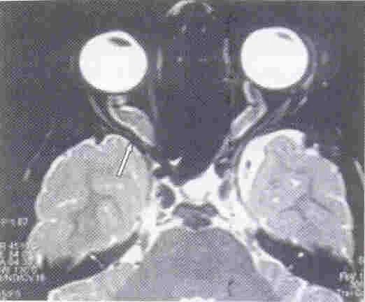 Глиома зрительного нерва мрт. Глиома зрительного нерва на кт. Нейрофиброматоз глиома зрительного нерва. Атрофия зрительного нерва кт. Периневральное пространство зрительного нерва