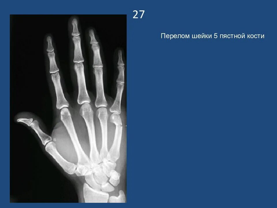 Закрытый перелом 5 пястной кости правой кисти. Подголовчатый перелом 2 пястной кости правой руки. Перелом 2 пястной кости. Перелом 5 пястной кости рентген. Закрытый перелом 5 пястной кости правой кисти.