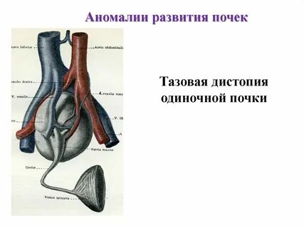 Аномалии мочеполовой системы