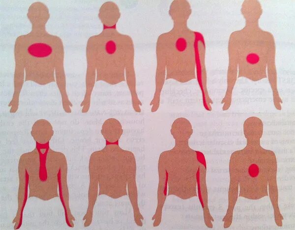 Инфаркт миокарда иррадиация боли. Болевые зоны при инфаркте миокарда. Локализация боли при инфаркте миокарда. Локализация боли в грудной клетке.