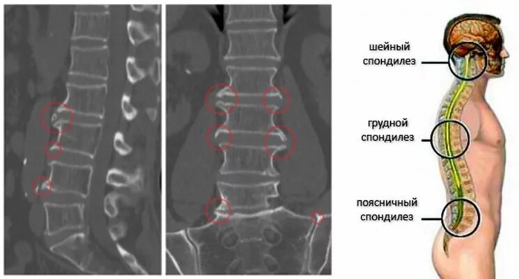 Спондилеза спондилоартроза поясничного отдела позвоночника. Спондилез с3-с7. Спондилез l3-l6. Деформирующий спондилез l1-l3. Деформирующий спондилез с3-с4.