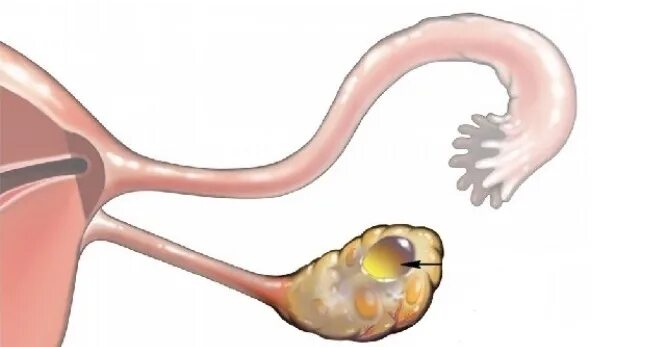 Желтое тело что это значит простыми словами. Киста желтого тела яичника дифференциальная. Фолликулярная киста яичника клиника. Фолликулярная киста желтого тела. Ретенционная киста яичника.