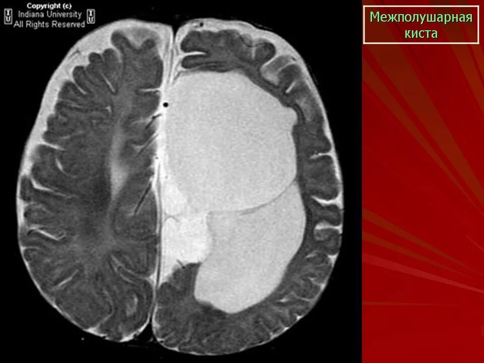 Врожденная киста в голове. Межполушарная киста головного мозга.