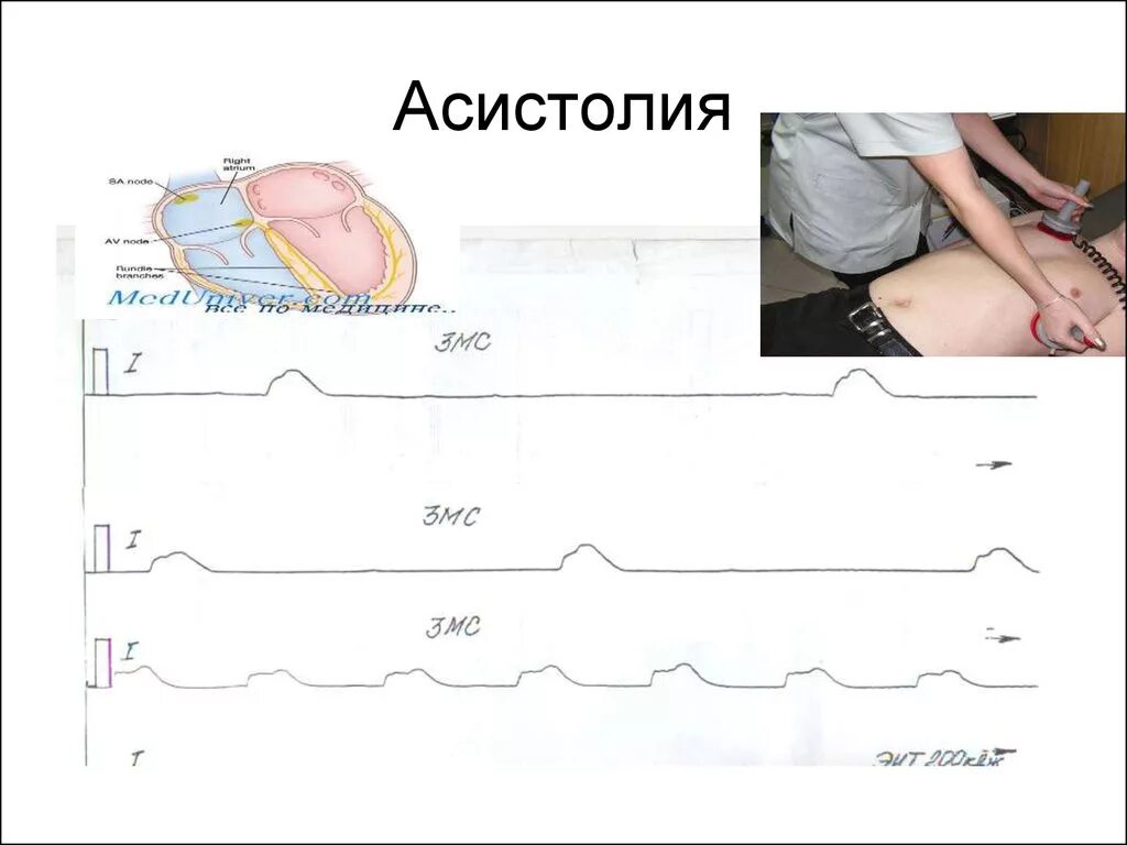 Асистолия что это. Асистолия. Асистолия на ЭКГ. Асистолия доклад. Асистолия реанимация.