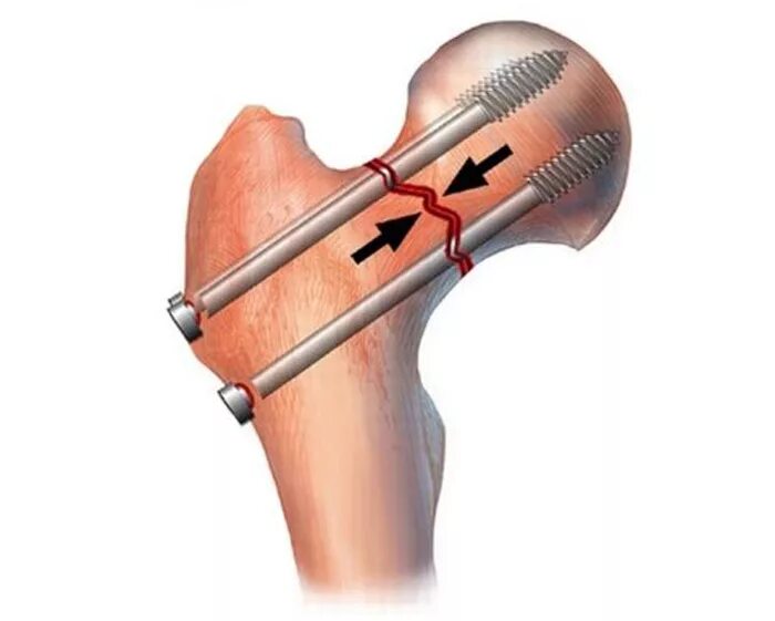 остеосинтез шейки бедра. остеосинтез тазобедренного сустава винтами. винтообразный перелом бедренной кости. бедренная кость спицы. бедренная кость спицы.