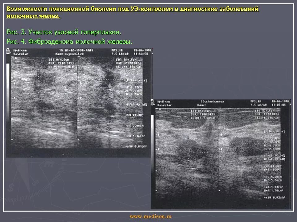 УЗИ С пункцией молочных желез. Биопсия молочной железы под контролем УЗИ. УЗИ молочных желез с пункционной биопсией.