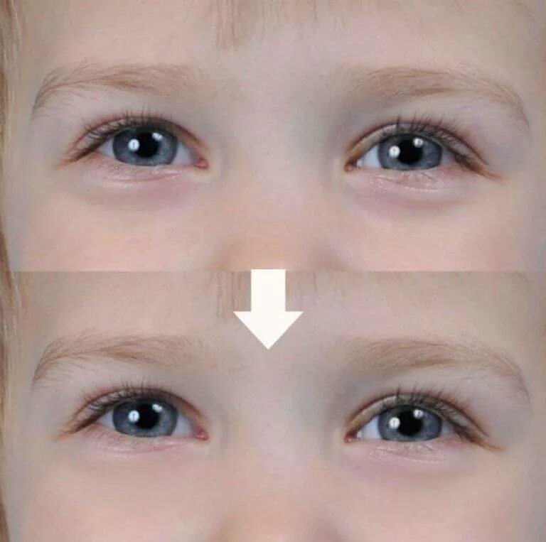 Ребенок 3 года бледный. Припухлость под глазами у ребенка. Мешки под глазами у ребенка.