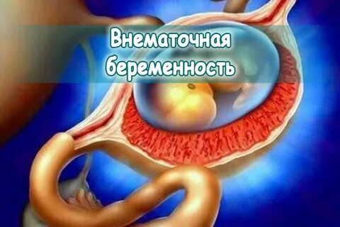 Забеременела левым яичником
