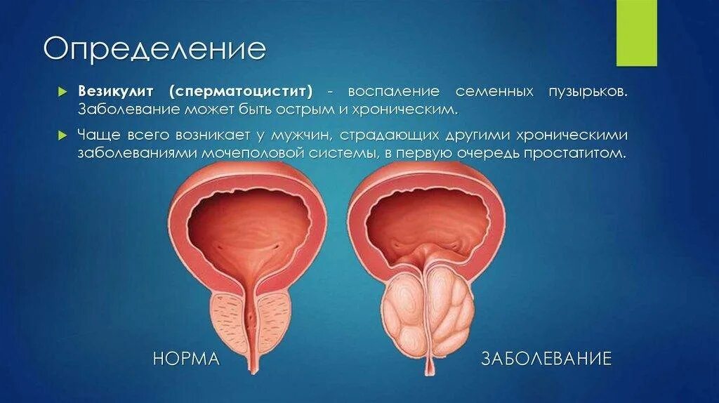 Везикулит у мужчин симптомы. Семенные пузырьки везикулит. Что такое везикулит предстательной железы. Воспаление семенных пузырьков.