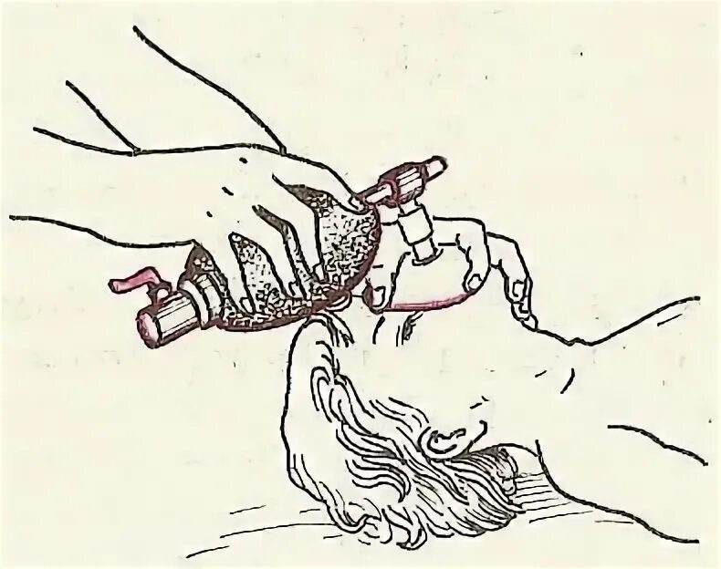 Искусственное дыхание мешком амбу. Искусственное дыханиемешок абу. искусственное дыхание с помощью мешка амбу алгоритм. искусственная вентиляция лёгких мешок амбу. искусственное дыхание ивл.
