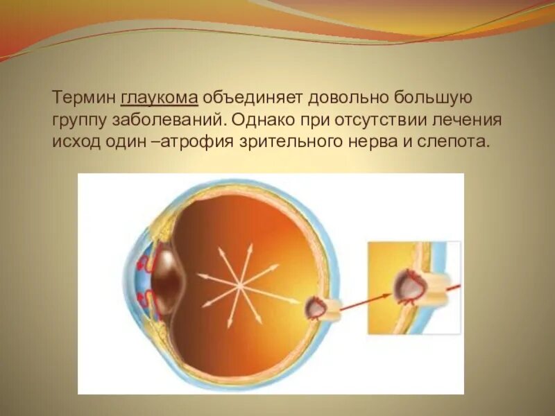 Тема урока глаз. К слепоте при глаукоме приводит.