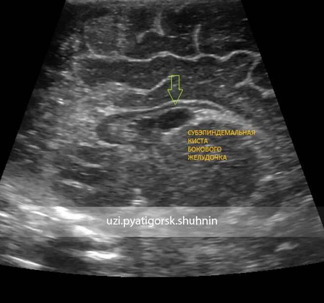 У плода киста мозга сплетения. Субэпендимальная киста на УЗИ. Кисты сосудистых сплетений НСГ. Субэпендимальная киста НСГ. УЗИ субэпендимальной кисты головного мозга.