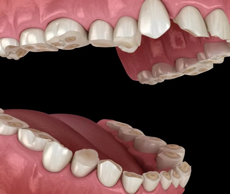 Почему жую зубы. Стираемость зубов бруксизм. Повышенная стираемость бруксизм. Бруксизм стирание зубов. Патологическая стираемость.