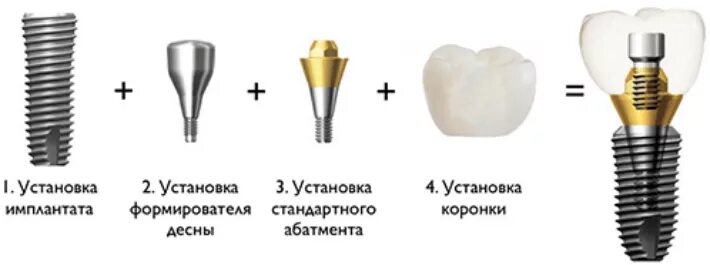 Насколько установлен. Схема имплант абатмент коронка. Имплант зуба абатмент формирователь. Имплант зуба схема установки. Имплант формирователь абатмент коронка.