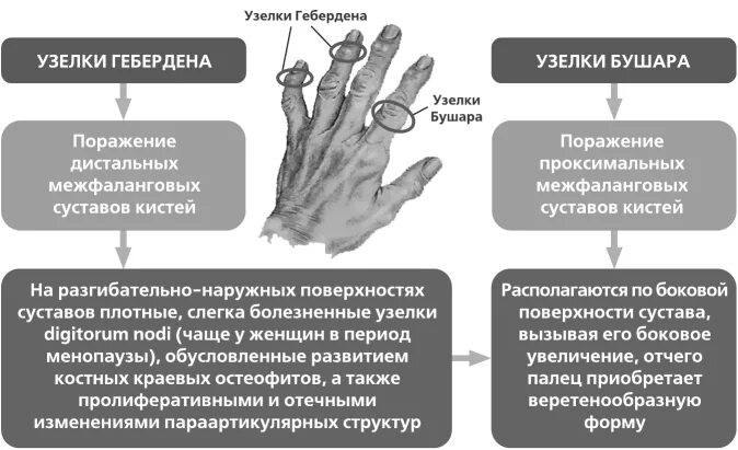 Межфаланговые суставы (узелки Гебердена, Бушара);. Остеоартроз узлы Гебердена. Остеоартроз Гебердена и Бушара. Узелки Гебердена при остеоартрите. Артрит межфаланговых