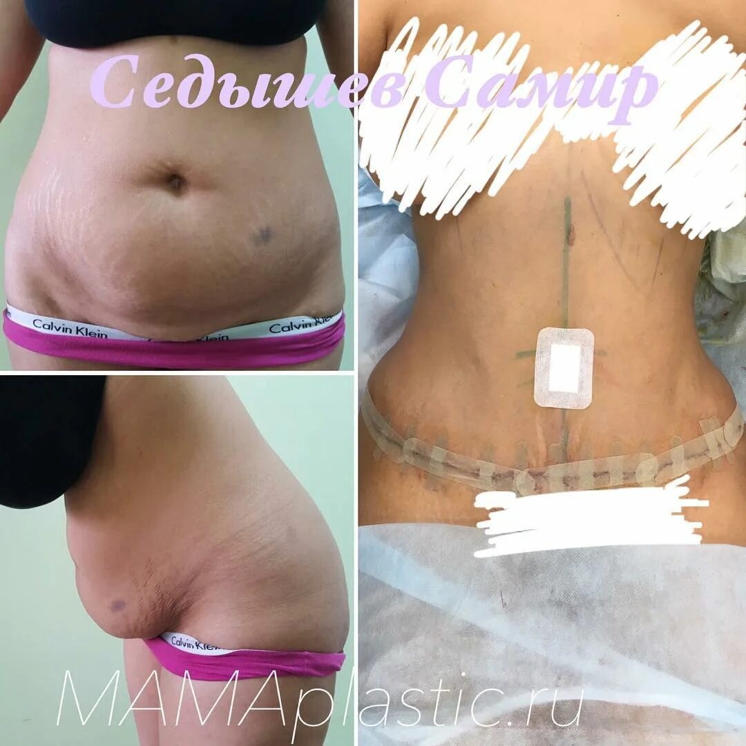 Операция на пупок до и после New plastic surgery technique makes belly fat look like chiseled abs