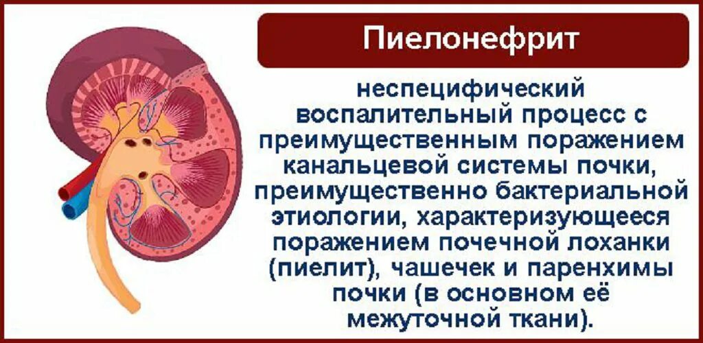 Заболевание почек пиелонефрит. Пиелонефрит неспецифический воспалительный процесс с поражением. Пиелит это