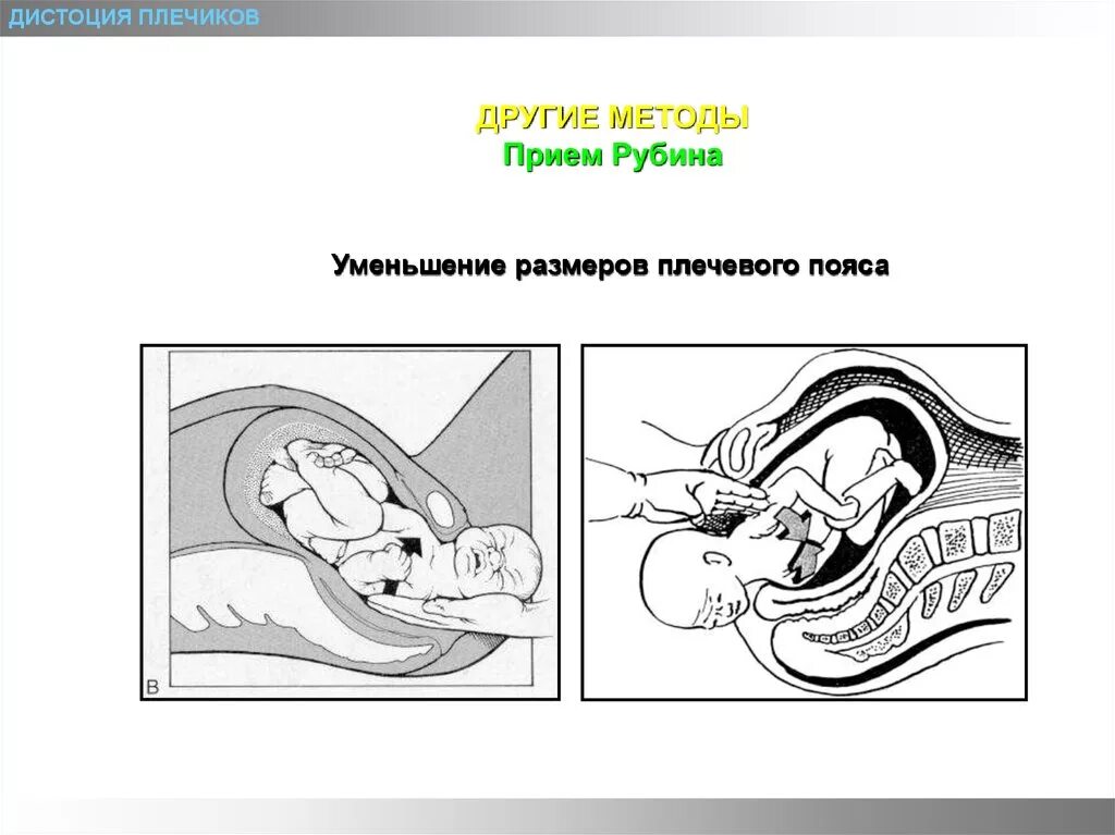 Мак робертса. Мак робертса