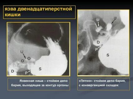 Синдром язвенной болезни 12 перстной кишки