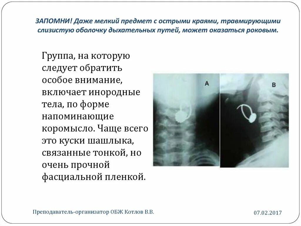 Инородные тела дыхательных путей причины. Инородное тело в дыхательных путях. Инородные тела верхних дыхательных путей. Инородный предмет в дыхательных путях. Попадание инородного тела в дыхательные пути.