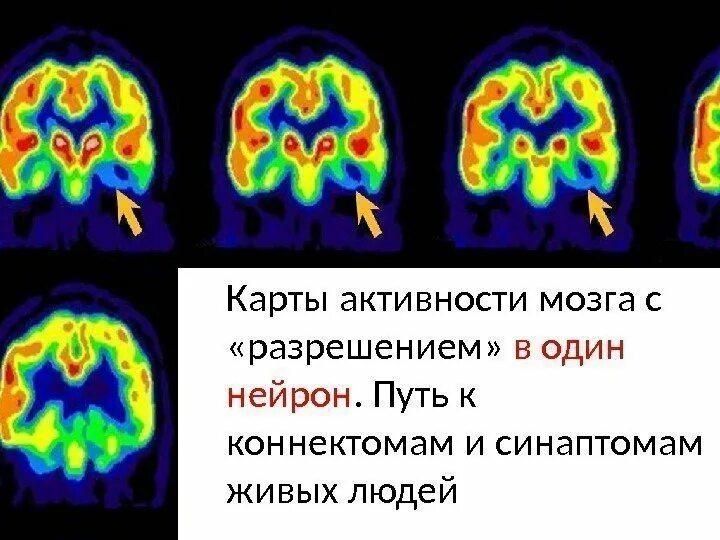 Диффузная активность мозга