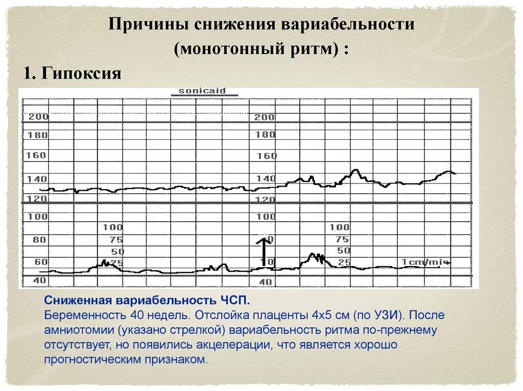 Норма чсс при беременности. Ктг при беременности расшифровка расшифровка. нормальные показатели ктг плода. патологические ритмы ктг. кардиотокография плода расшифровка норма.