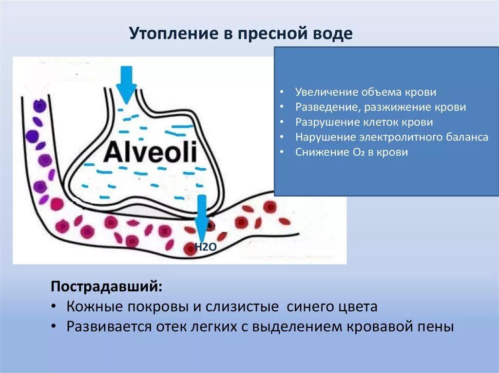 Воды попали в кровь. Утопление в пресной воде. Патогенез утопления в пресной и морской воде. Патогенез утопления в пресной воде. Патогенез утопления в морской воде.