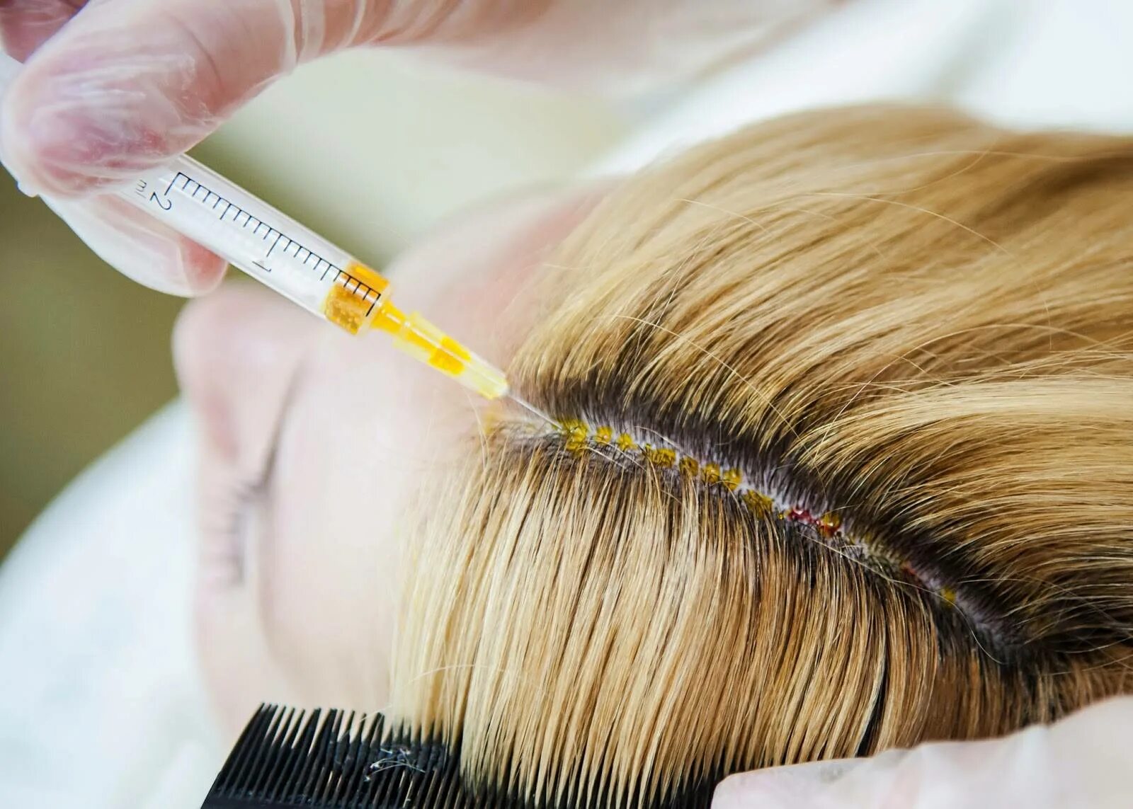Инъекции головы. Мезотерапия волосистой части головы. Мезотерапия для кожи головы и волос. Hair мезотерапия для волос. Мезо для волос.