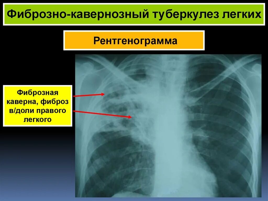 Поствоспалительный фиброз легких что это. Фиброз легких на кт. Фиброз в правом легком верхней доли. Фиброзно-кавернозный туберкулез легкого. Плевральные наслоения.